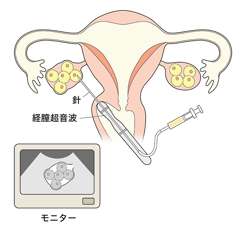 採卵 の 痛み どれくらい