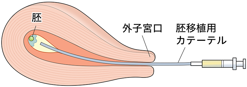 胚 移植 後 風邪 ひい た